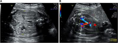 A novel PKHD1 splicing variant identified in a fetus with autosomal recessive polycystic kidney disease